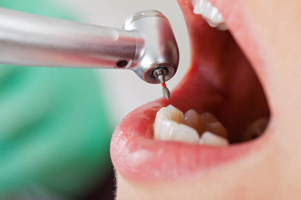 Best Emergency Wisdom Tooth Extraction in Palmyra, WI